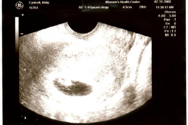 Baby #2's Ultrasound Pictures - NEW picture added February 3, 2009!