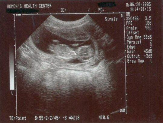 13 week ultrasound ~ The little one's getting bigger!