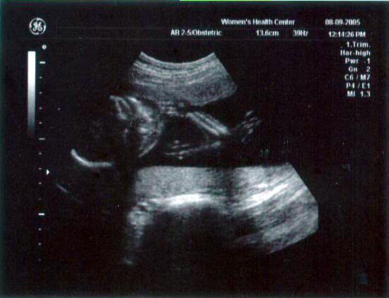 20 week ultrasound ~ Another alien shot, complete with arm and hand