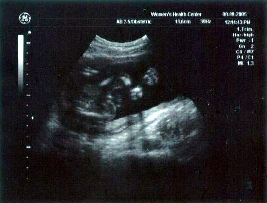 20 week ultrasound ~ Baby's leg and foot