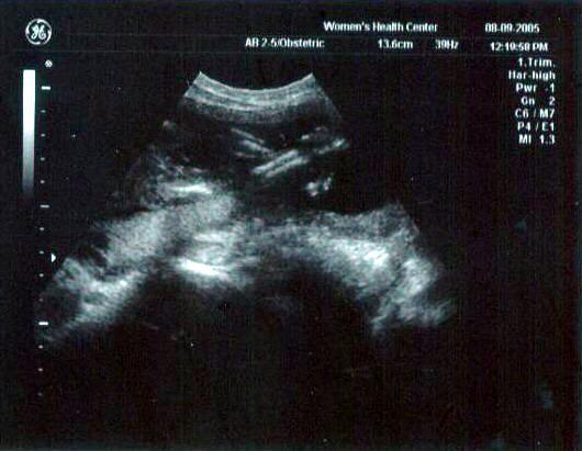 20 week ultrasound ~ Baby's legs are crossed -- see, he or she WANTS to be a surprise!