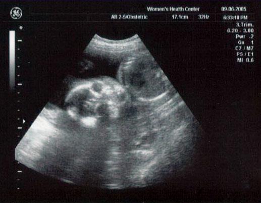 24 week ultrasound ~ Our little alien caught in mid-yawn! (Tilt your head to the left if you need to...)