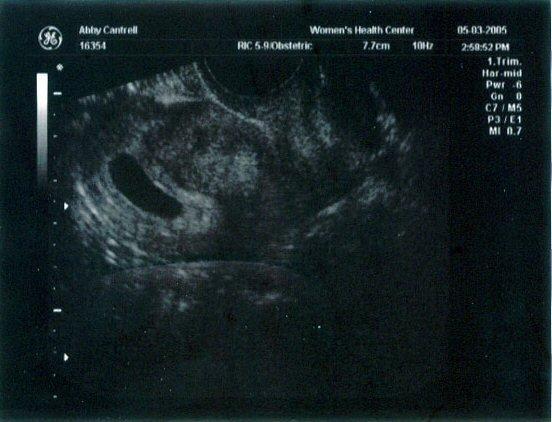 6 week ultrasound ~ Just a little black sac -- nothing much to see yet...