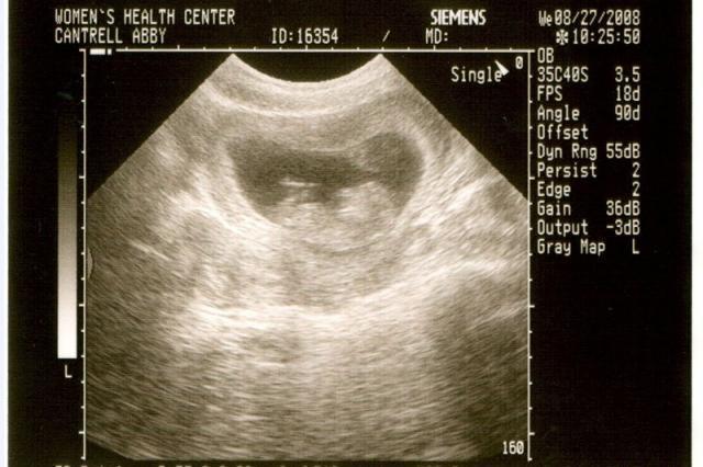 11 week ultrasound