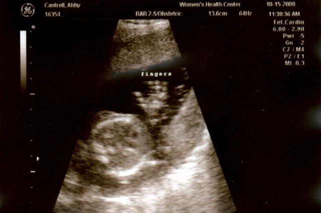 18 week ultrasound - hand