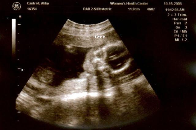 18 week ultrasound - face