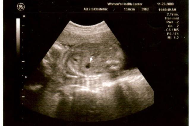 24 week ultrasound - stomach