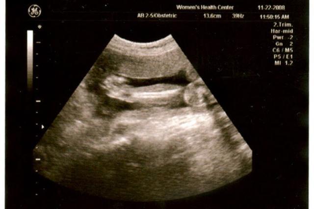 24 week ultrasound - arm and hand