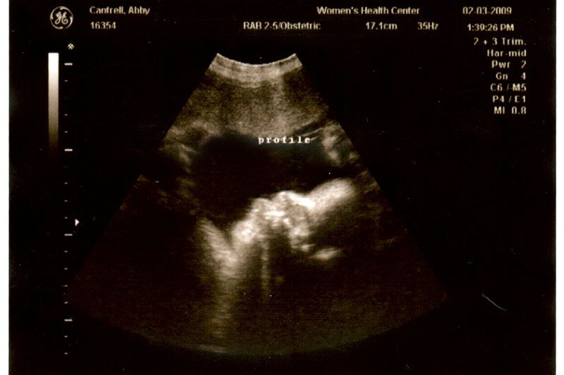 34 week ultrasound -- baby face profile