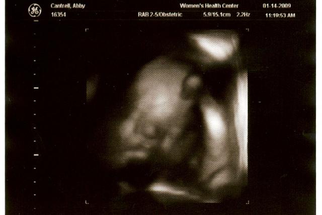 3D ultrasound, 31 weeks -- baby face, arm and hand