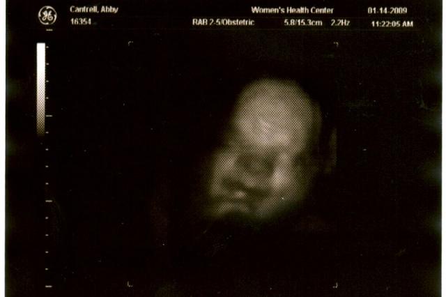 3D ultrasound, 31 weeks -- baby face