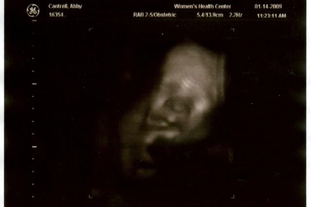 3D ultrasound, 31 weeks -- smooshed baby face